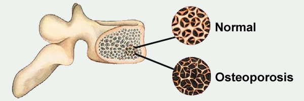 Illustration of health bone and bone with osteoporosis