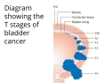 Diagram showing the T stages of bladder cancer