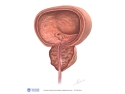 illustration of Hyperplasia: enlarged Prostate