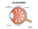 illustration of the eye showing eye pressure causing optical nerve damage