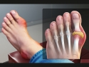  Medical image showing swelling, joint stiffness and aching around the joint in foot, especially the big toe..