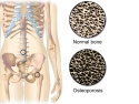 Illustration of skeleton showing common locations of Osteoporosis in spine and hip and illustration of normal bone and much thinner bone in Osteoporosis