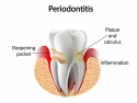 illustration of tooth, plague near gum line, and inflammation below gum line
