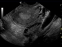 Ultrasound showing a polycystic ovary
