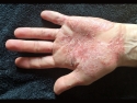 person's left hand with psoriasis: red splotchy areas on palm and base of fingers