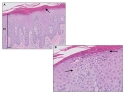 Micrograph of psoriasis vulgaris